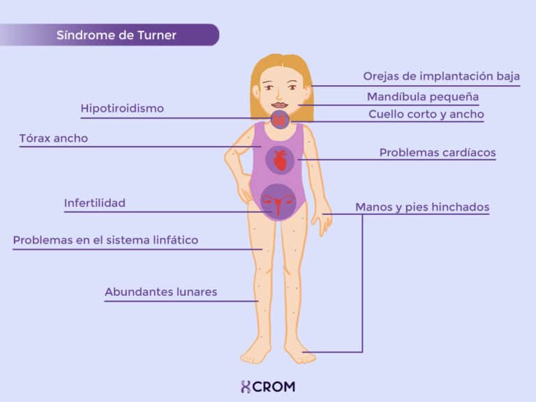 Ficha técnica: Síndrome de Turner – CROM – Instituto de Citogenética Humana